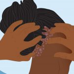treating-Hair-dandruff
